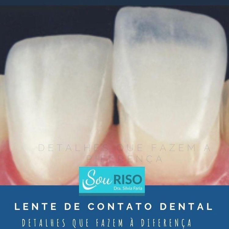 Lente de contato dental desenvolve estética do sorriso