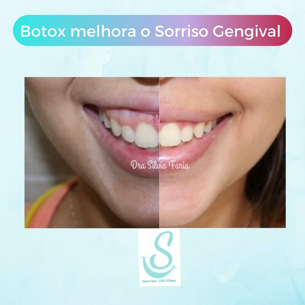 Botox melhora o Sorriso Gengival