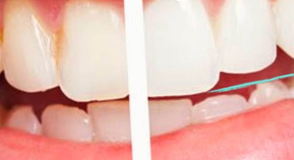 Clareamento Dentário