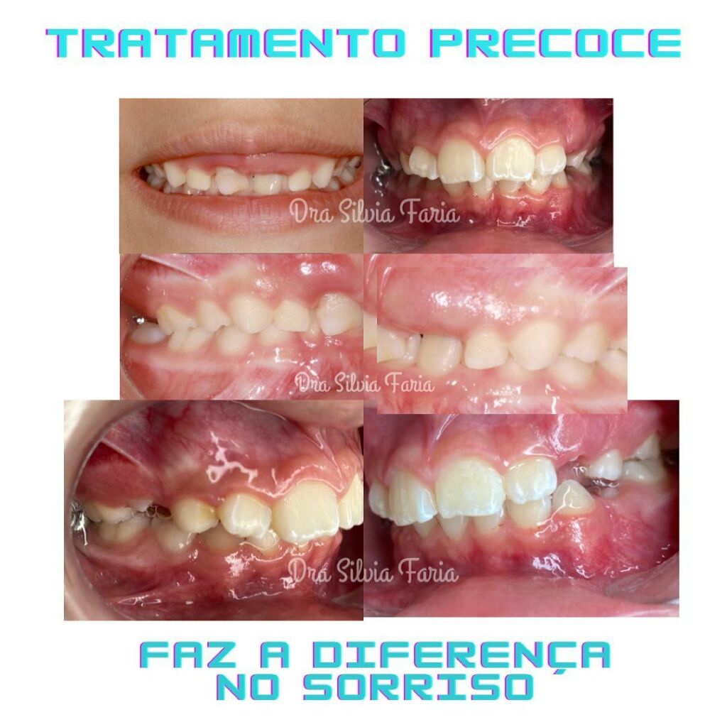 Tratamento Precoce faz a diferença no sorriso