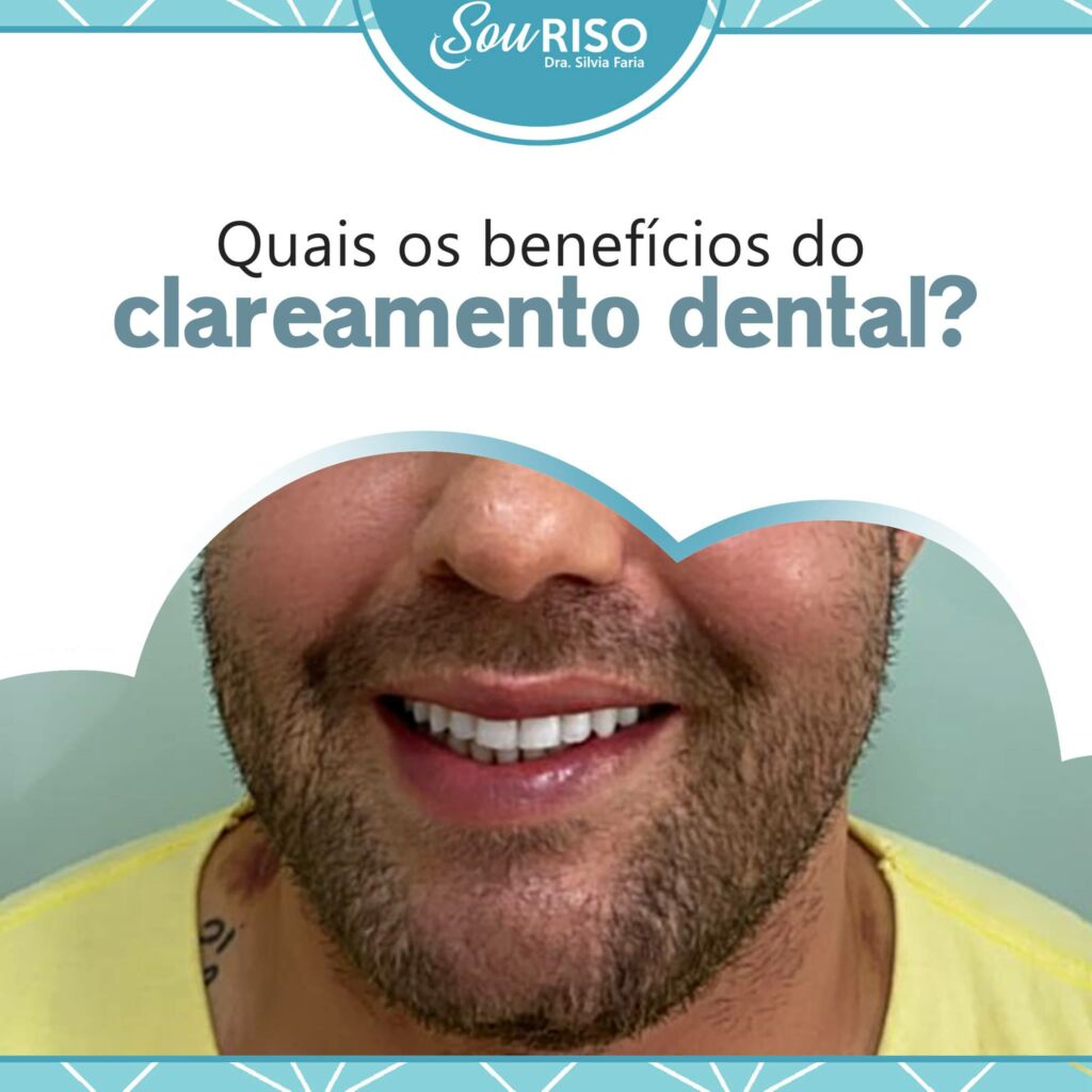 Quais os benefícios do clareamento dental