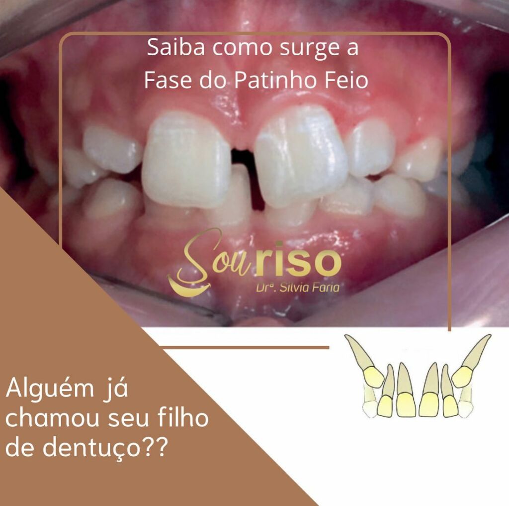 Alguém já chamou seu filho de dentuço?