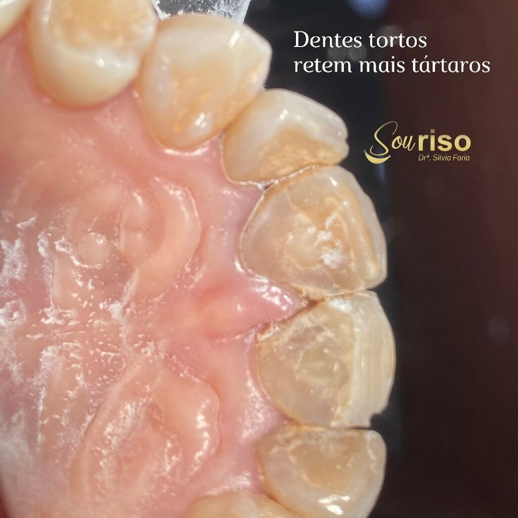 Dentes Tortos retém mais tártaros