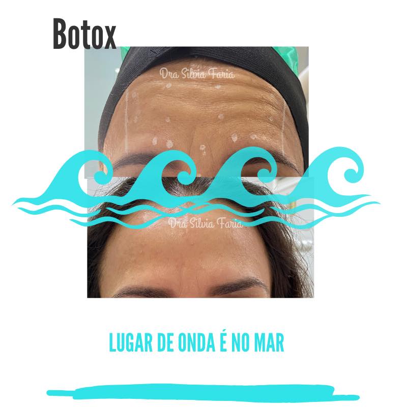 Botox lugar de onda é no mar