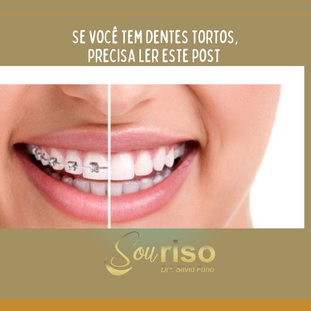 Se você tem dentes tortos, precisa ler este post