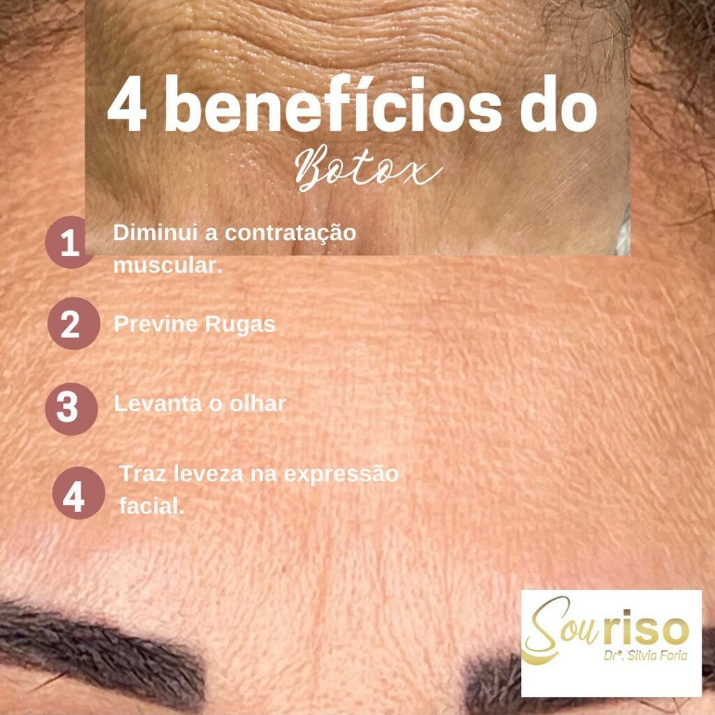 4 Benefícios do Botox