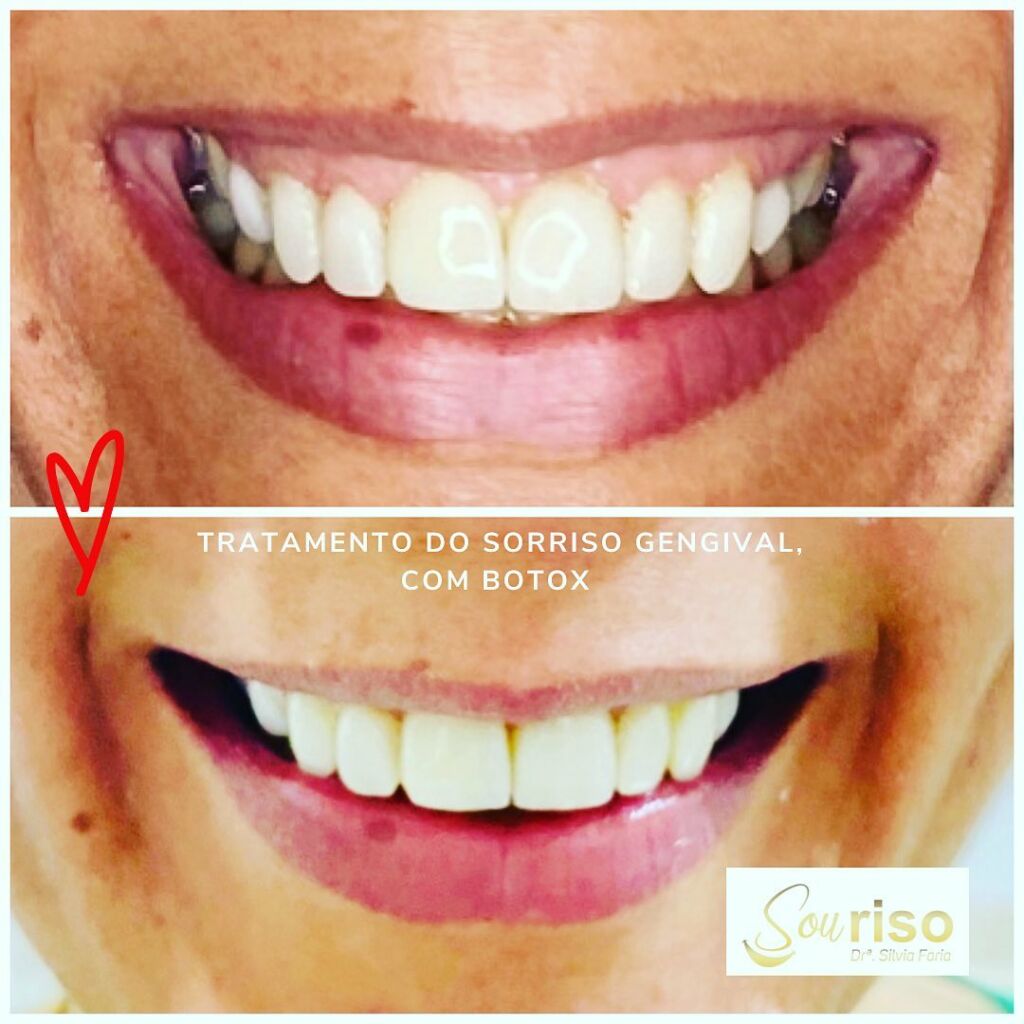 Tratamento do Sorriso Gengival com Botox