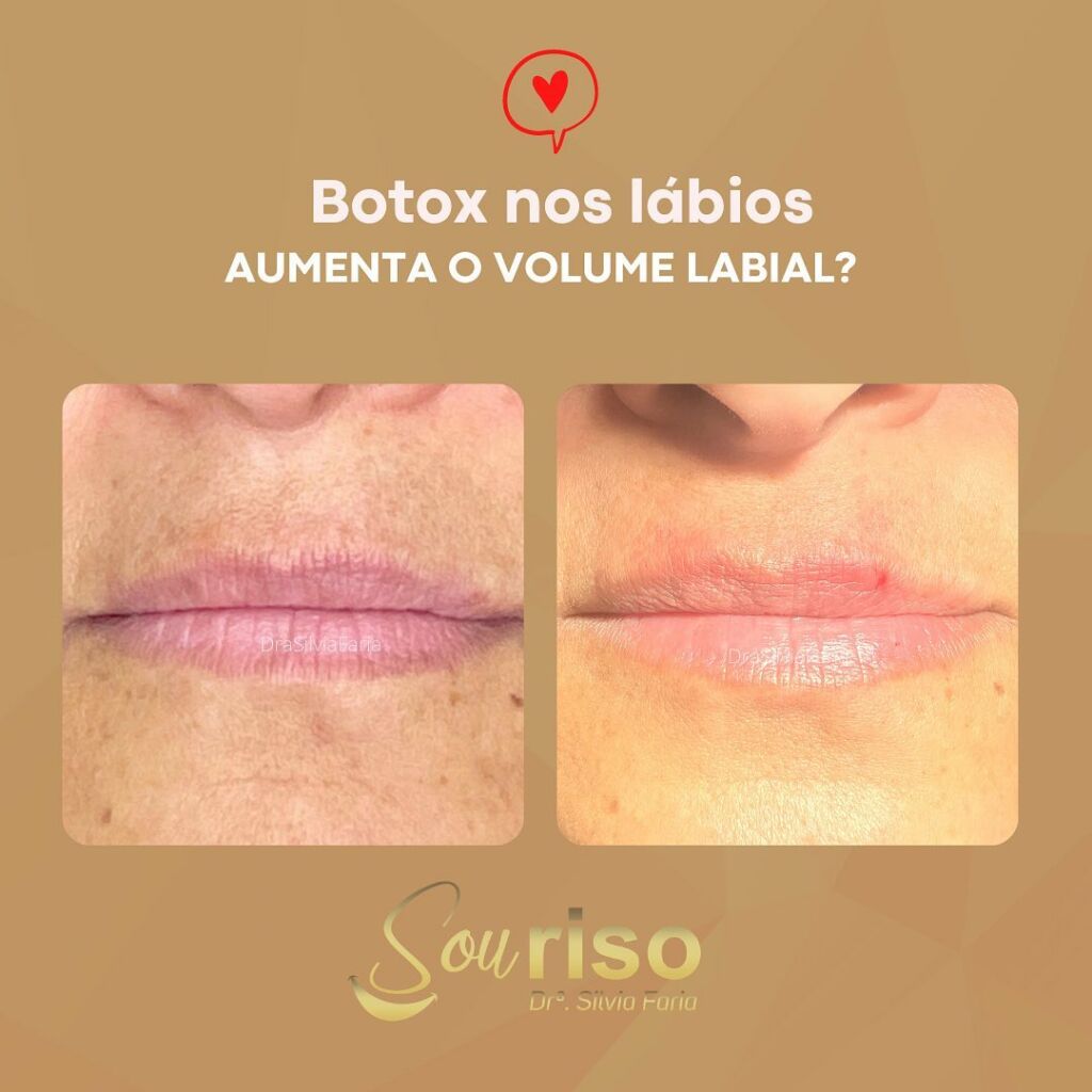 Botox nos lábios aumenta o volume labial?