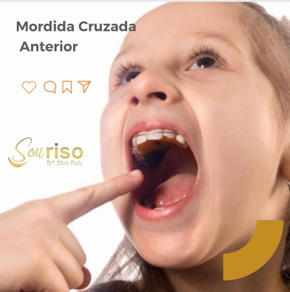 Mordida Cruzada Anterior