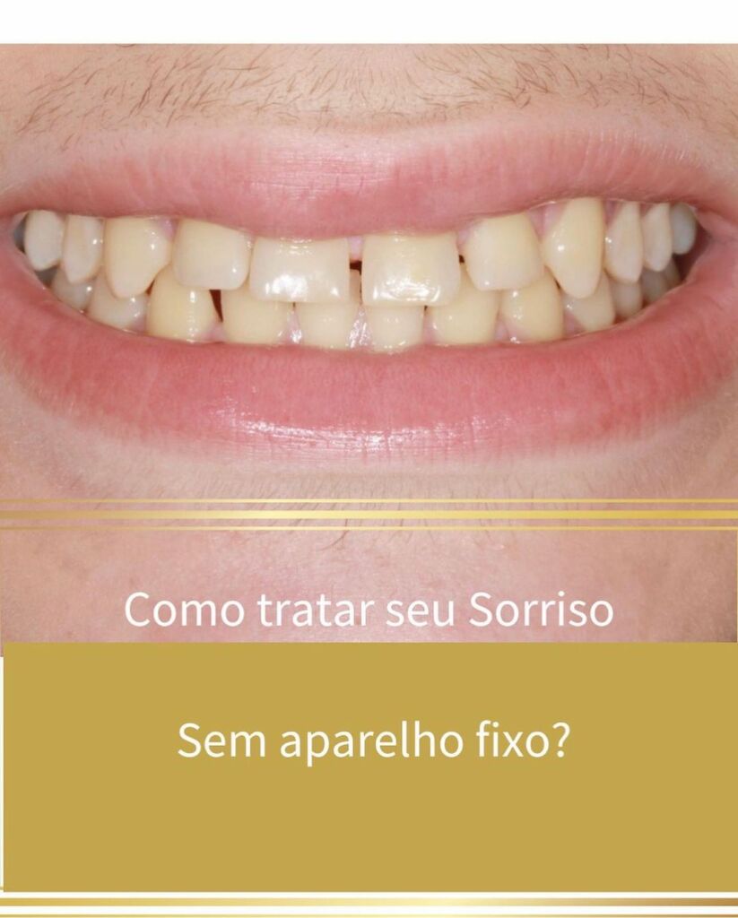 Como tratar seu Sorriso sem aparelho fixo