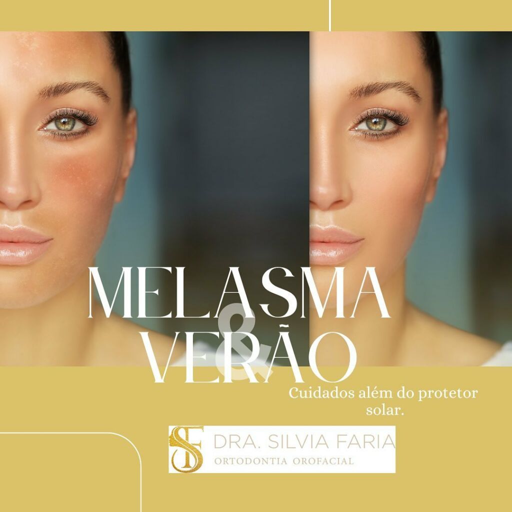 Manchas de melasma são mais comuns no verão