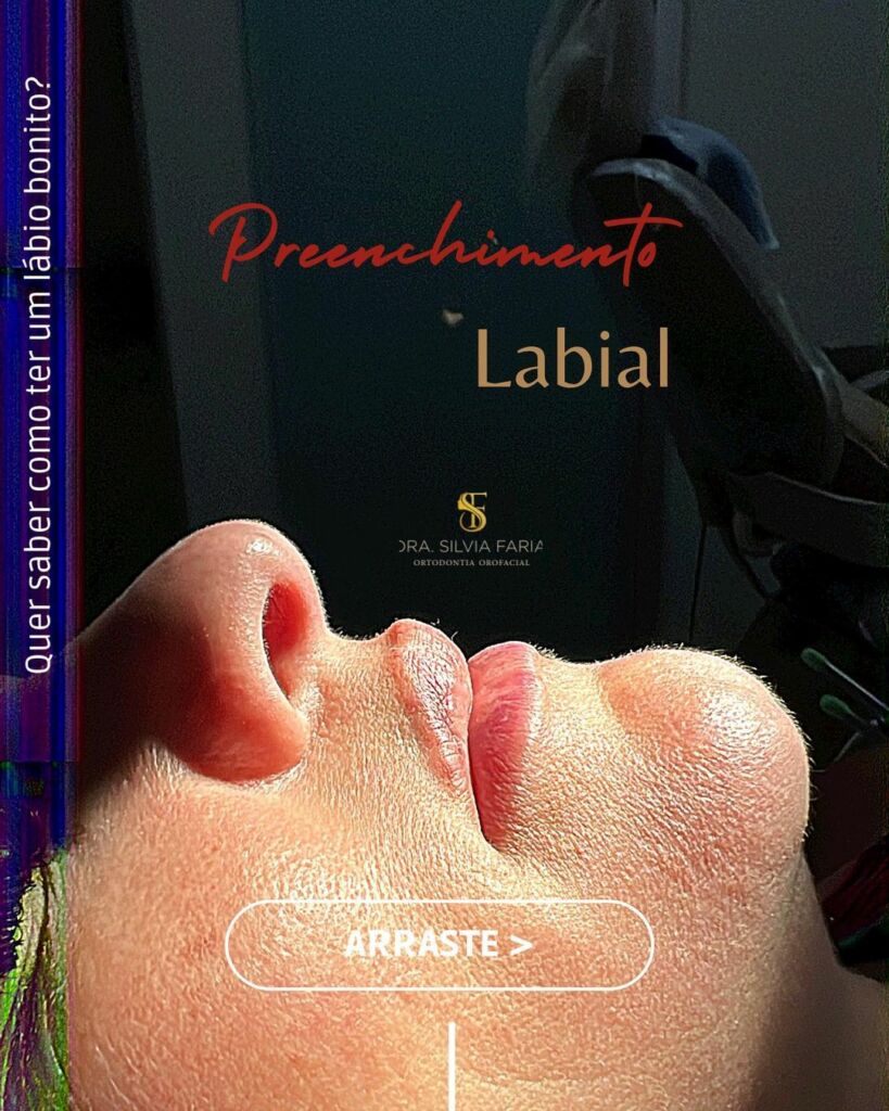 Preenchimento Labial