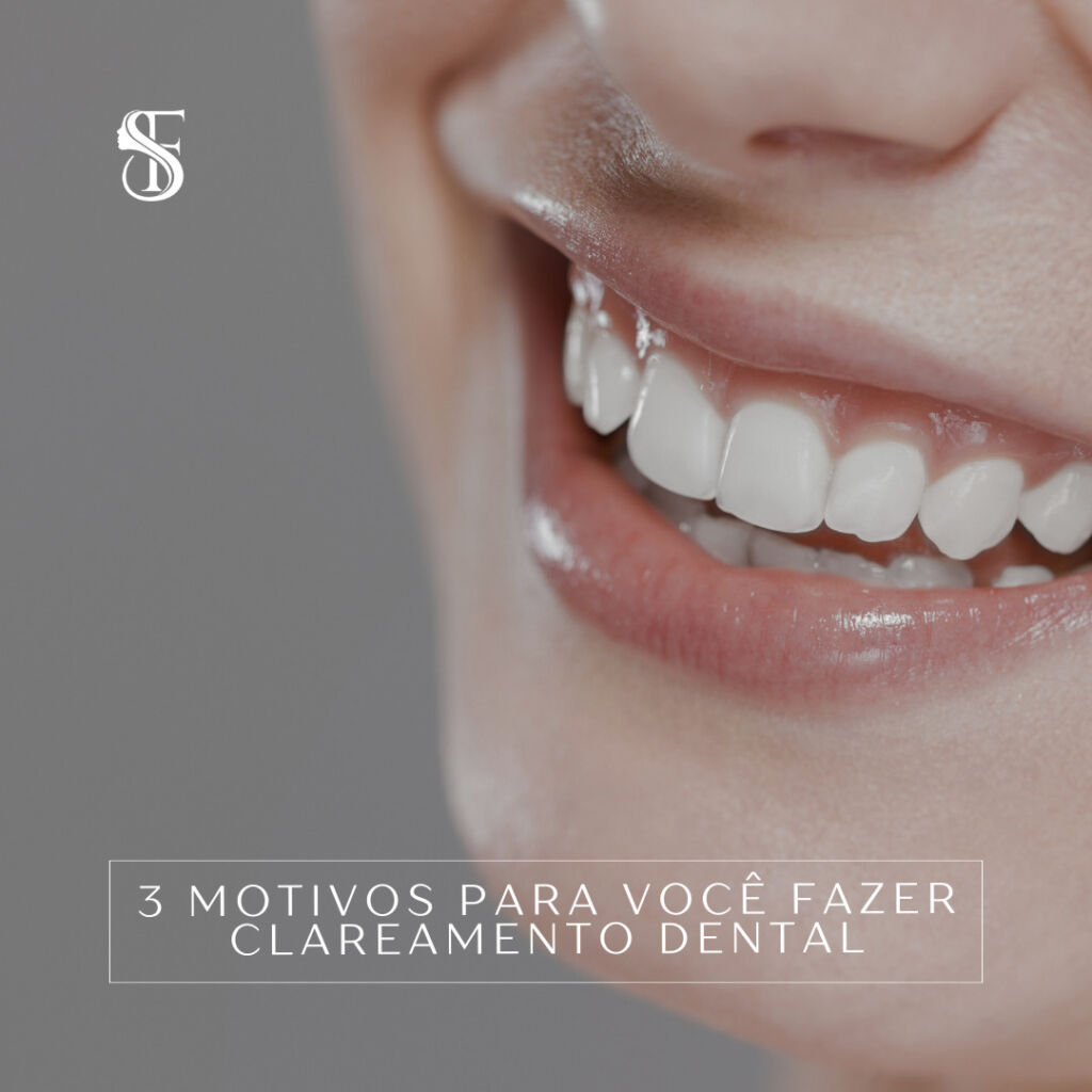 3 Motivos para você fazer clareamento Dental