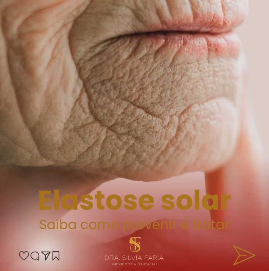 Elastose solar, saiba como prevenir e tratar