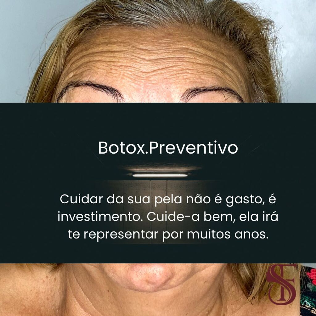 O que é o Botox preventivo?