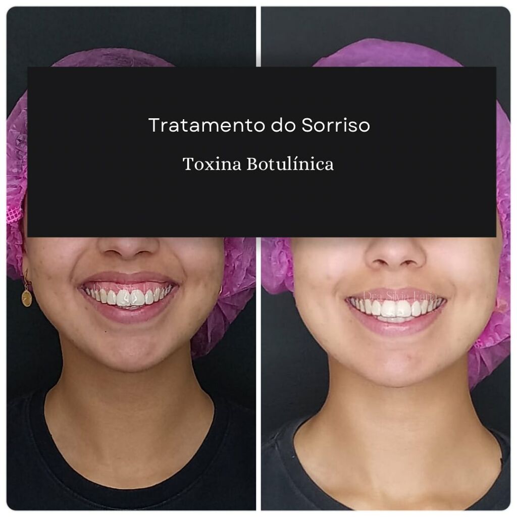 Tratamento do Sorriso, Toxina Botulínica