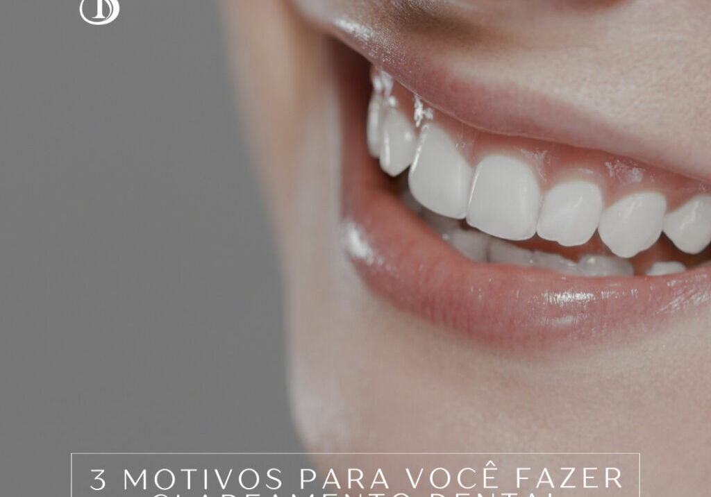 3 Motivos para você fazer clareamento Dental