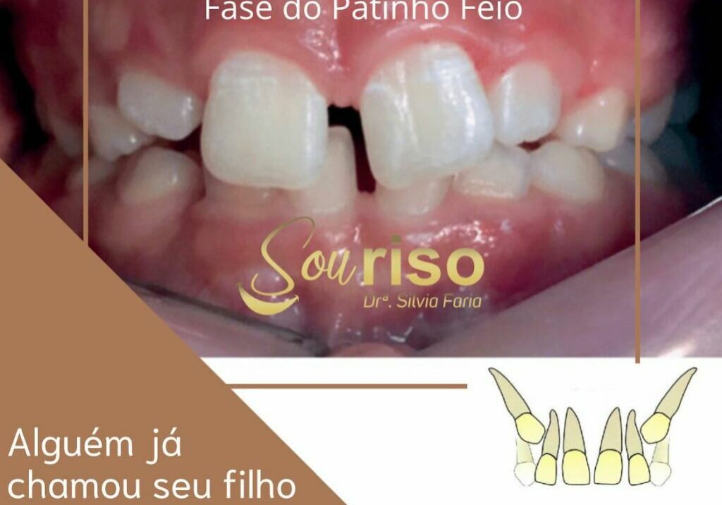 Alguém já chamou seu filho de dentuço?