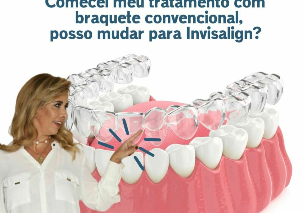 Comecei meu tratamento com braquete convencional, posso mudar para Invisalign?