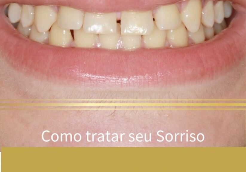 Como tratar seu Sorriso sem aparelho fixo