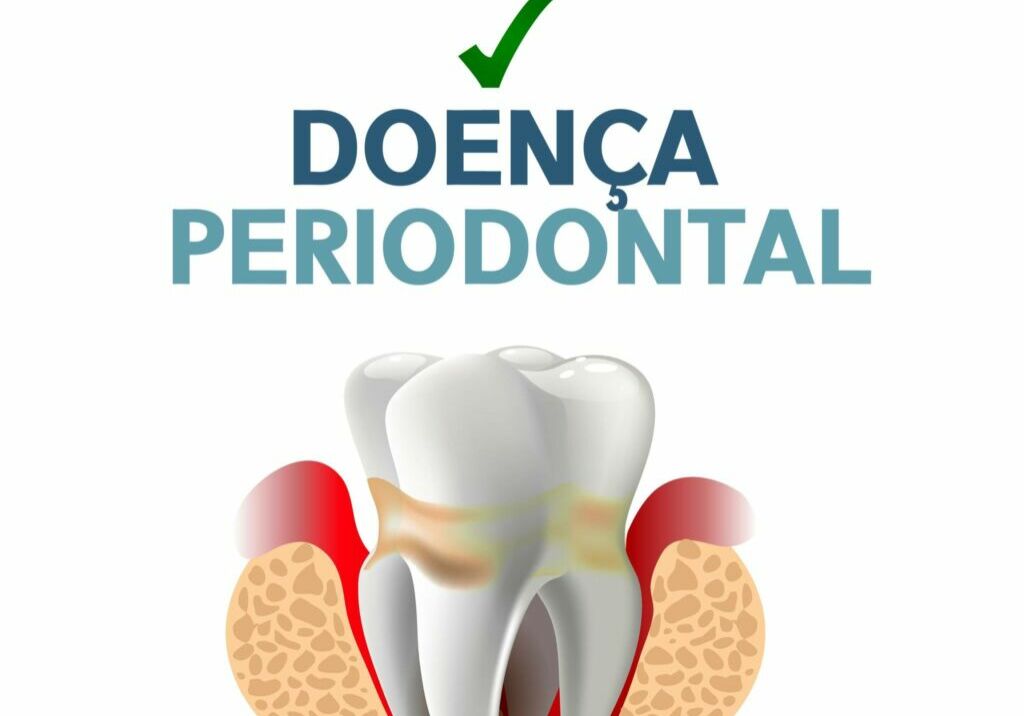 Doença Periodontal