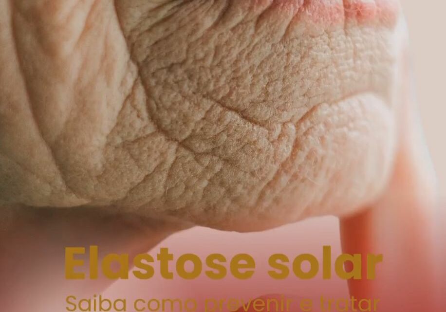 Elastose solar, saiba como prevenir e tratar