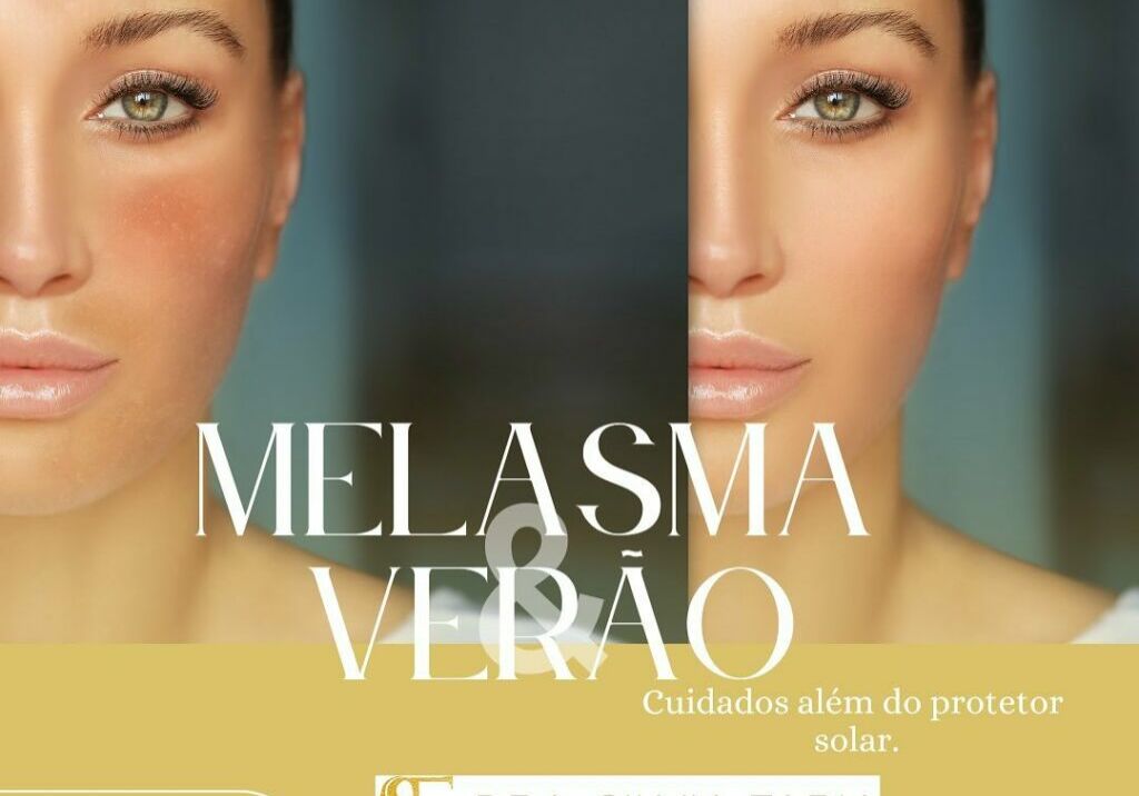 Manchas de melasma são mais comuns no verão