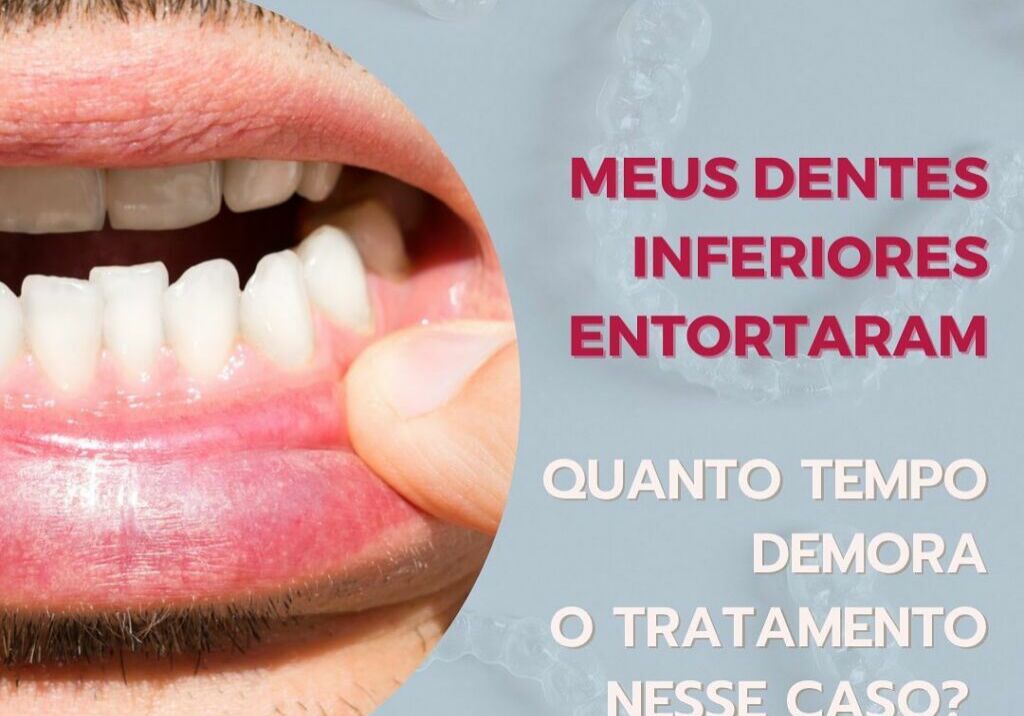 meus-dentes-inferiores-entortaram