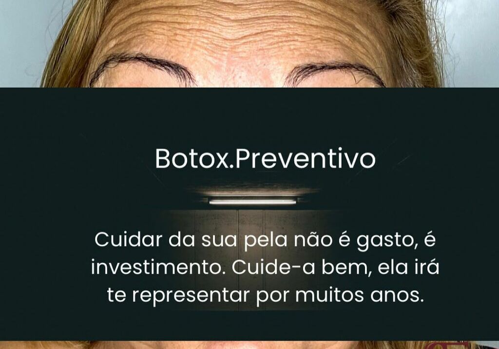 O que é o Botox preventivo?