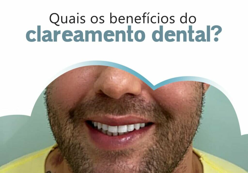 Quais os benefícios do clareamento dental