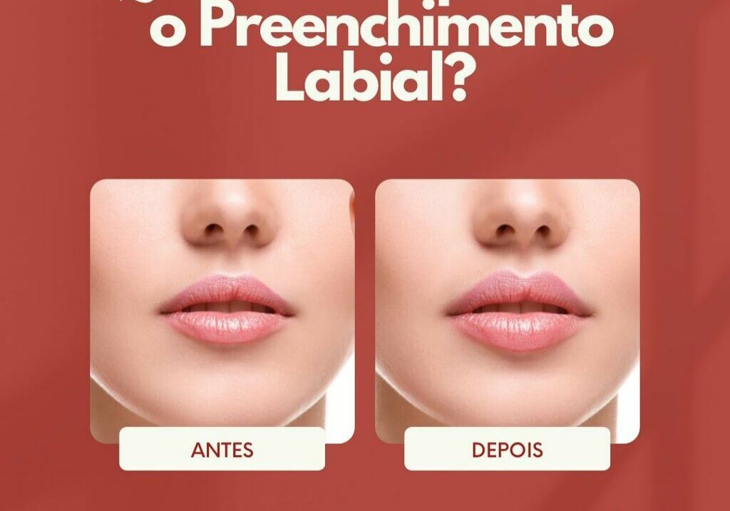 Quanto tempo dura o preenchimento labial?