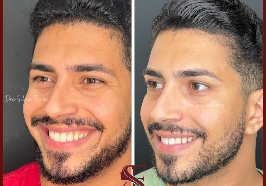 Que ver o resultado do Botox em um rosto Masculino