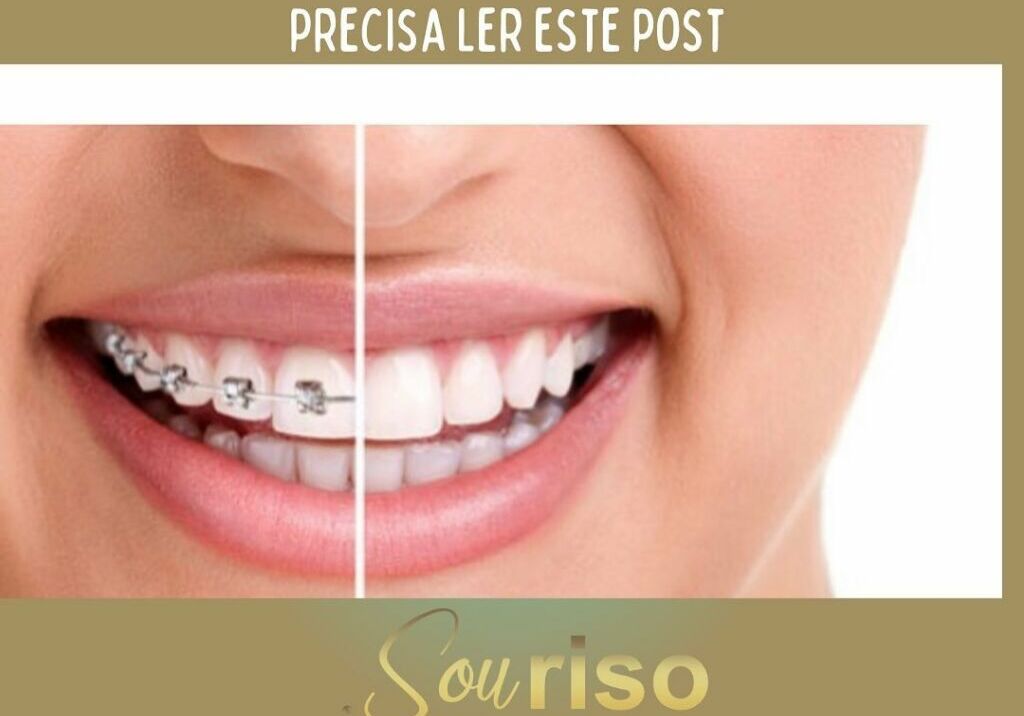 Se você tem dentes tortos, precisa ler este post