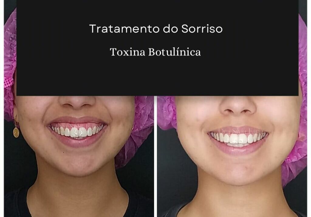 Tratamento do Sorriso, Toxina Botulínica